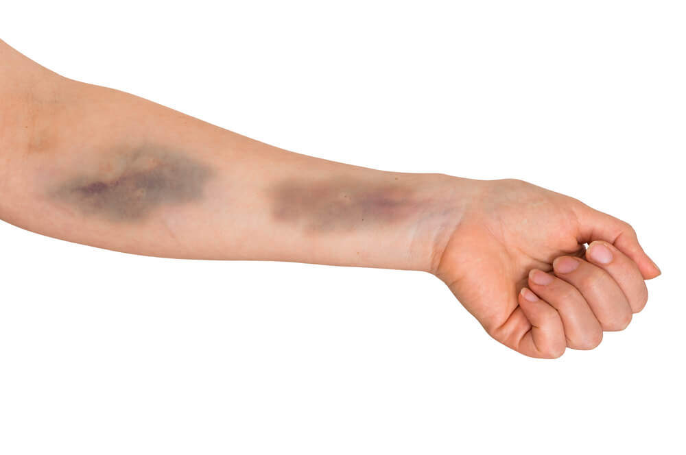 bruising-in-leukaemia-vs-ordinary-bruising-leukaemia-care